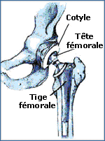 Prothèse -hanche