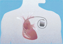 Boîtier de défibrillation en sous-cutané sous la clavicule Boîtier de défibrillation en sous-cutané sous la clavicule
